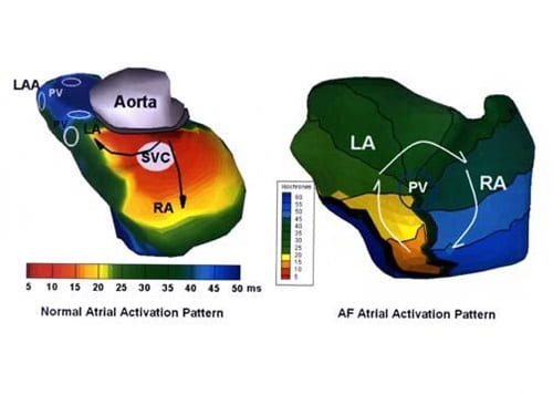 Images of a normal atrial activation patter and AD atrial activation pattern. 